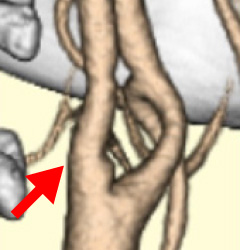 頚動脈内膜剥離術(CEA) | 頸動脈狭窄症の外科治療 | 脳神経外科紹介 