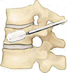 バルーンを徐々に膨らませ、つぶれた骨を持ち上げ、できるだけ骨折前の形に戻します。