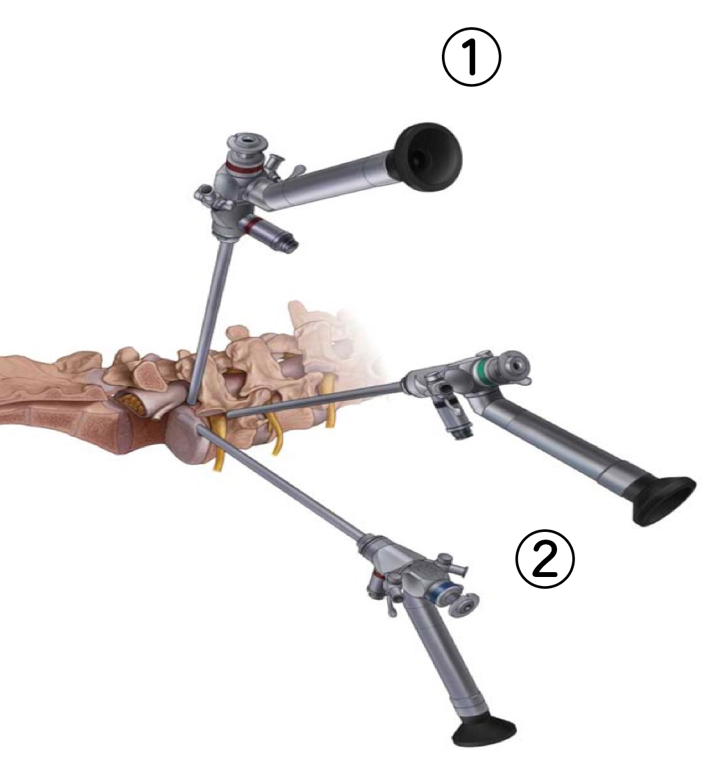 経皮的・内視鏡下・椎間板後方摘出術(PELD) | 脊椎・脊髄外科紹介 