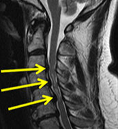 術前: 脊柱管狭窄により障害された頚髄が白く描出されている