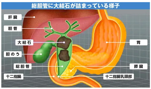 内視鏡手術＝「内視鏡下胆道結石砕石術」が可能です