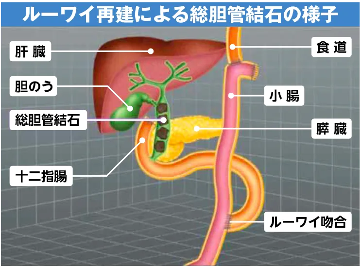 ルーワイ再建による総胆管結石の様子