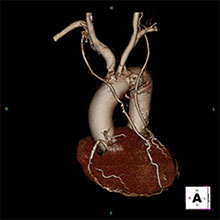 冠動脈バイパス術後3次元CT