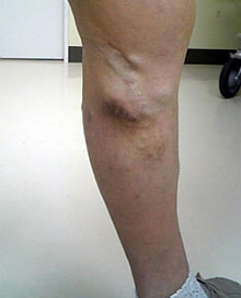 うっ滞性皮膚炎を伴った下肢静脈瘤