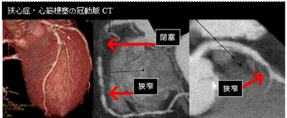 冠動脈CT2