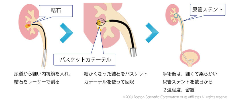 内視鏡を使用した経尿道的尿管砕石術（TUL）