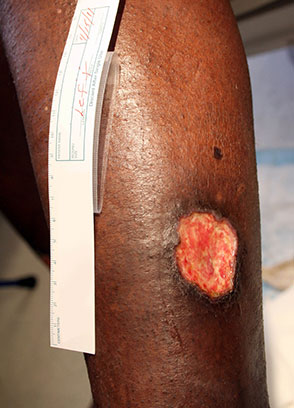 潰瘍、色素沈着