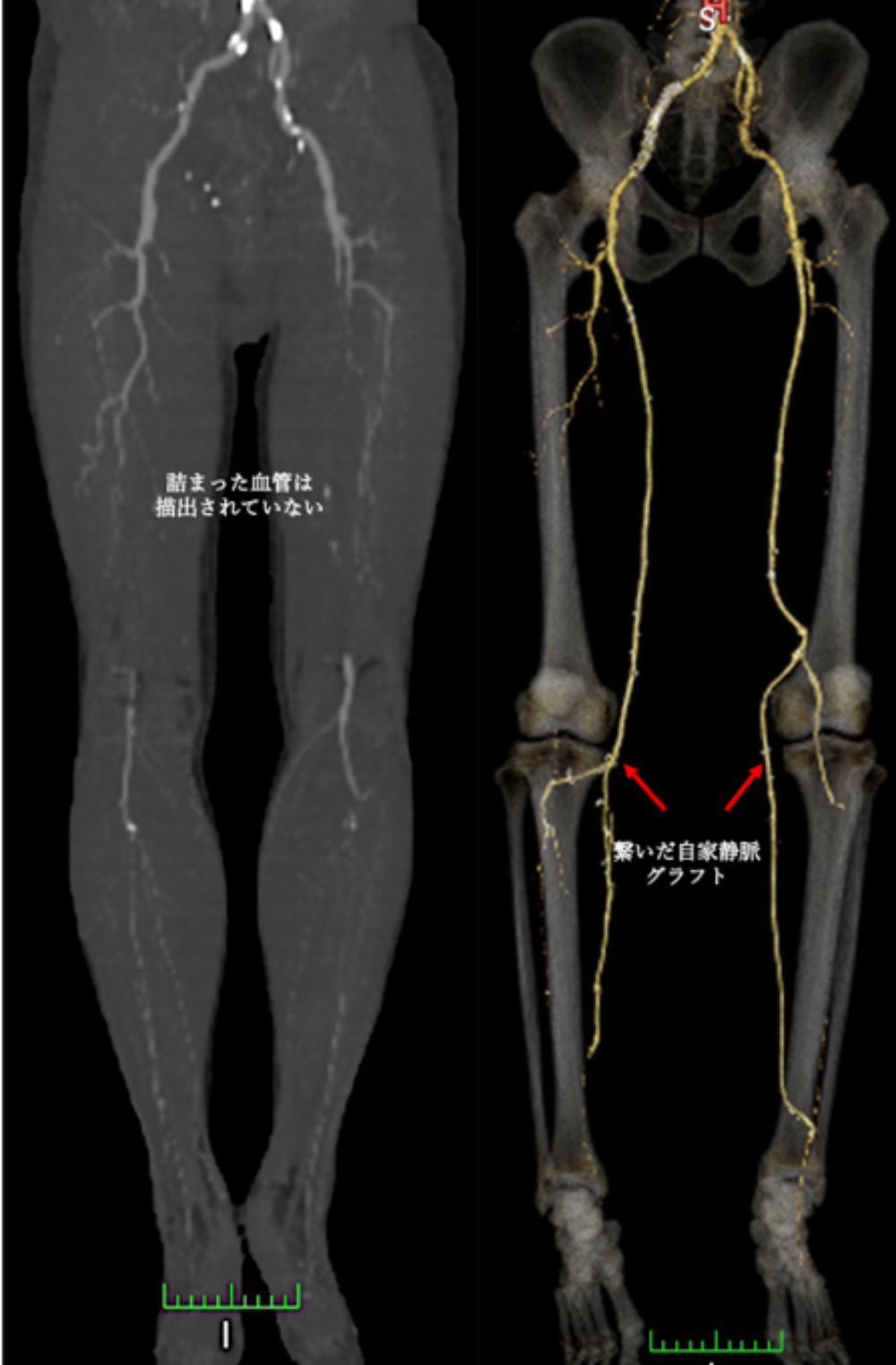 両下腿バイパス術:右総大腿動脈-膝窩動脈/後脛骨動脈バイパス+左総大腿動脈-膝窩動脈-後脛骨動脈バイパス
